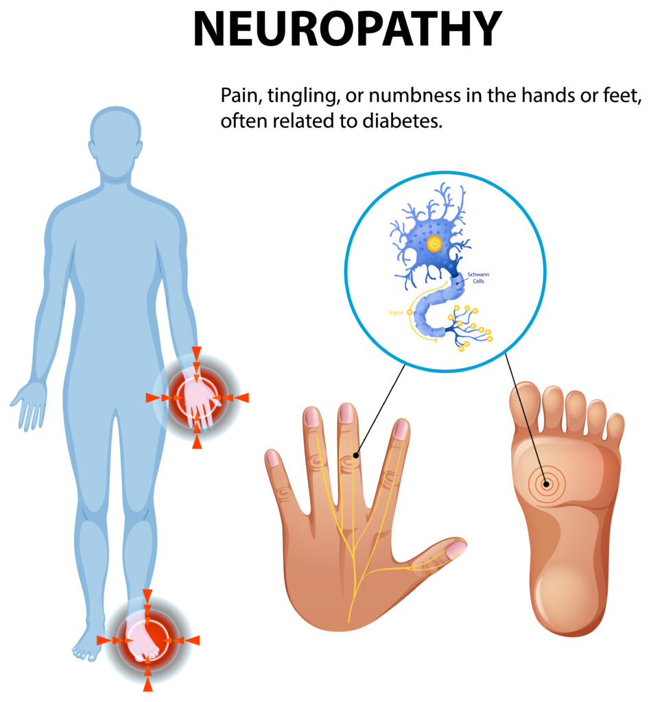 Diagram showing the diabetes and neuropathy relationship in human nerves