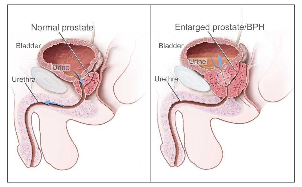 enlarged prostate