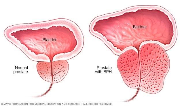 What Is BPH? Benign prostatic hyperplasia and enlarged prostate