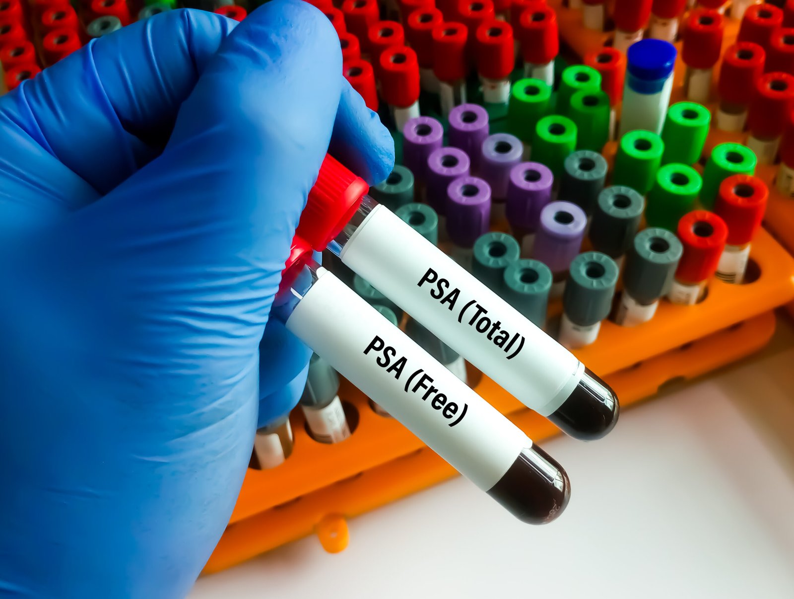 PSA blood test for prostate health