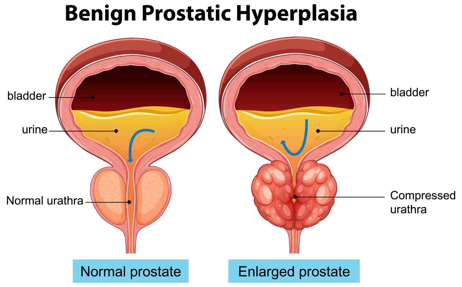 Medical illustration showing enlarged prostate and urinary flow