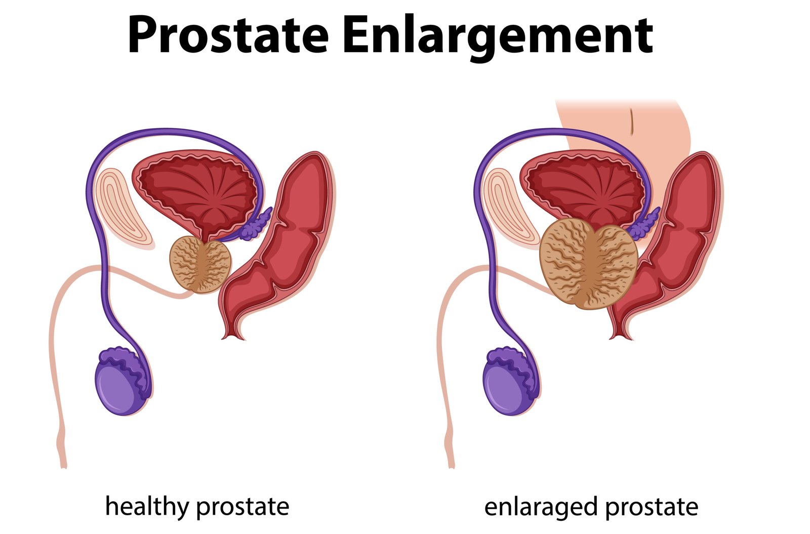 Medical illustration of the prostate and prostatitis